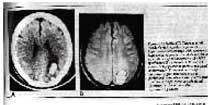 Intracerebral Hemorrhage Following Electroconvulsive Therapy (ECT)