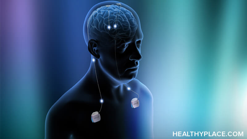Deep brain stimulation treats severe neurological disorders. Learn about deep brain stimulation for depression procedure, side effects and cost.